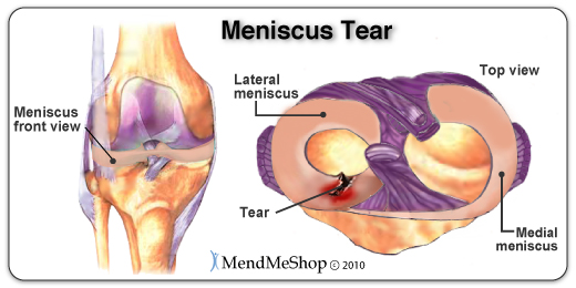 What is the recovery time for a minor meniscus tear surgery?