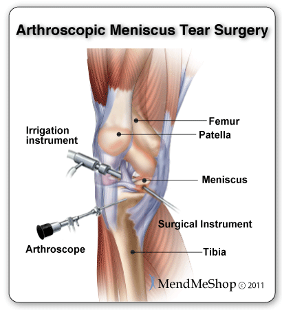 Arthroscopic meniscus surgery trims meniscus tears