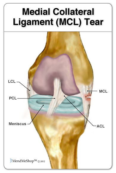 MCL Cluster  Diagnosting Medial Collateral Ligament Injuries