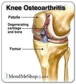 Osteoarthritis can result when a meniscus tear goes left untreated.