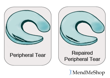 A peripheral meniscus tear may be sutured to assist with repair